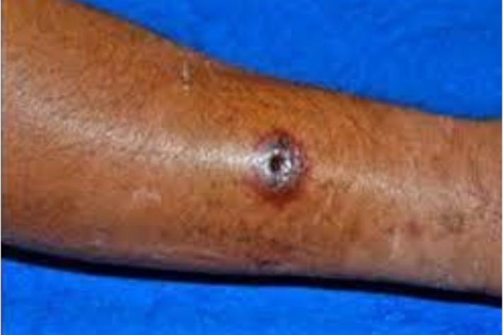 anthrax_maladie_du_charbon_250_jpg_711_473_1